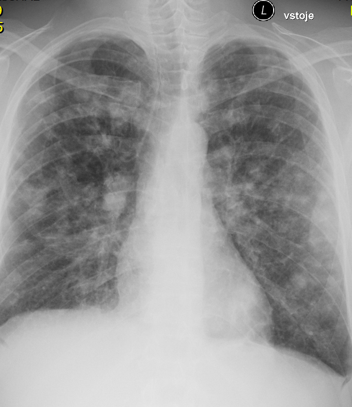 RTG plic s mnohočetnými metastázami na plicích
